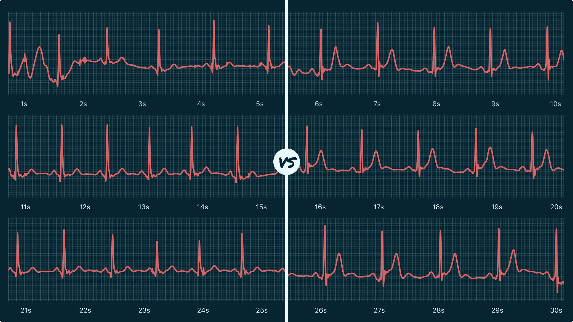 Sinus Rhythm Vs. Sinus Bradycardia on Your Watch ECG Qaly